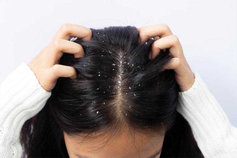 هيئة الدواء توجه سلسلة من النصائح لوقاية الشعر من قشرة الرأس