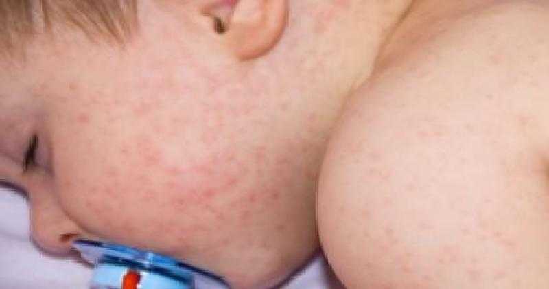 أسباب وأعراض الإصابة بالحساسية.. طرق علاج فعالة