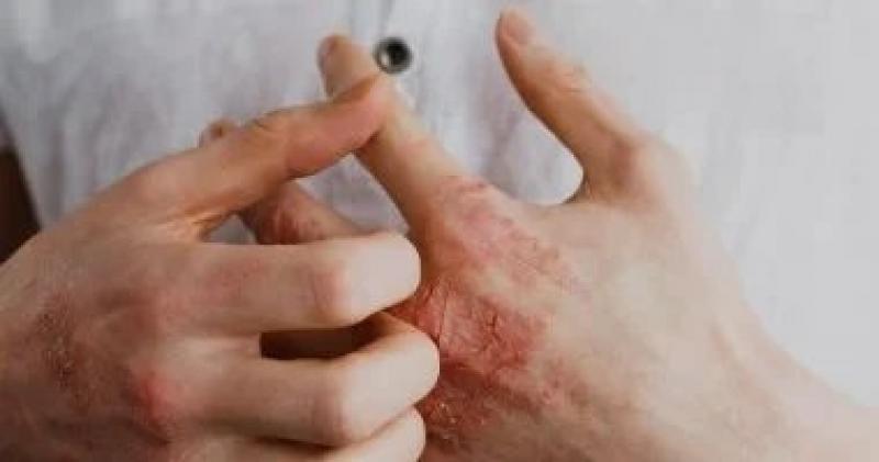 أشهر مشاكل الصيف الجلدية.. إزاى تحمى نفسك