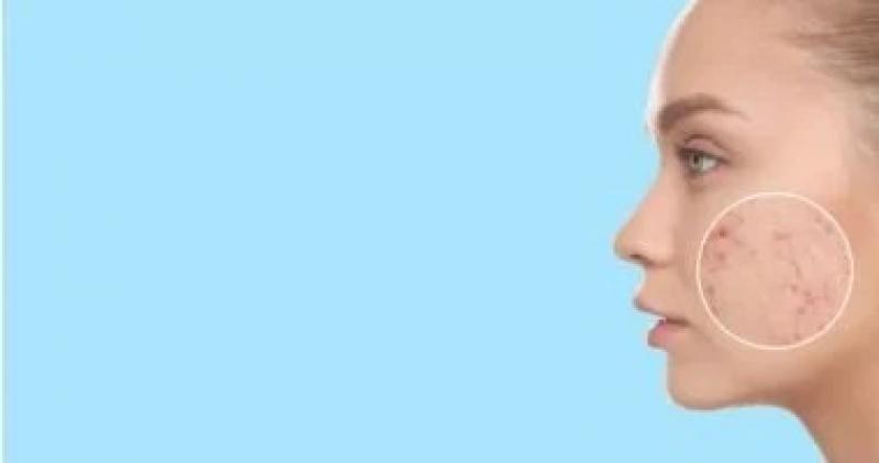 أسباب ظهور حب الشباب فى الرقبة.. كيف تتخلص منه