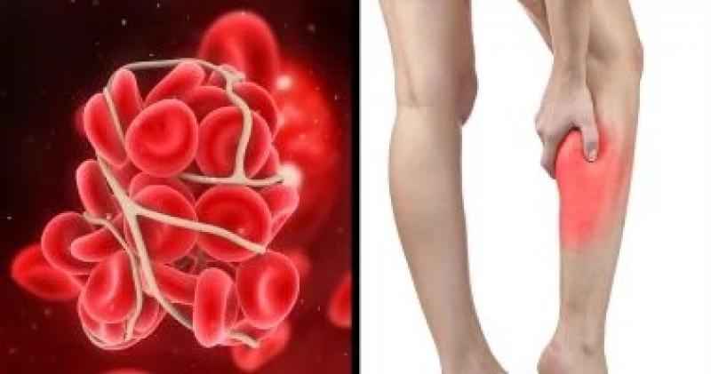 جلطات الدم فى الساقين.. أبرز الأعراض وطرق العلاج والوقاية