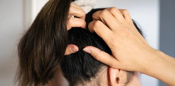 وصفات طبيعية لعلاج حب شباب فروة الرأس.. مشكلة مزعجة حلولها بسيطة
