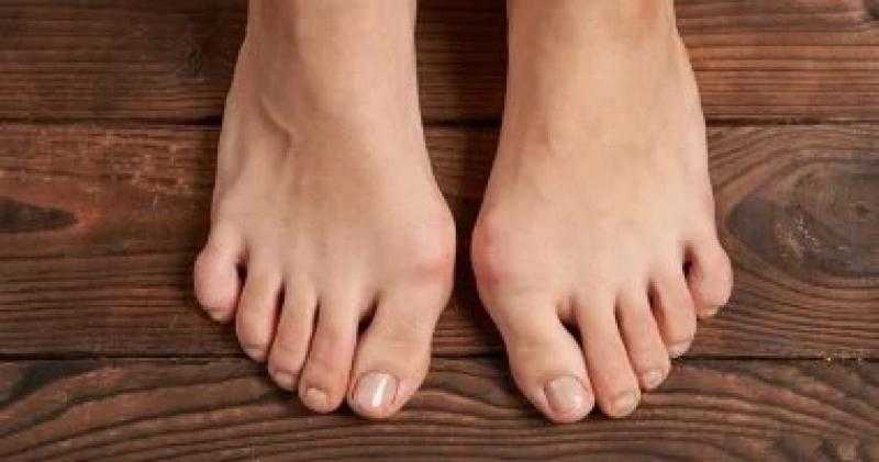 طرق طبيعية للتخلص من رائحة القدم الكريهة.. عشان ما تحسيش بالإحراج
