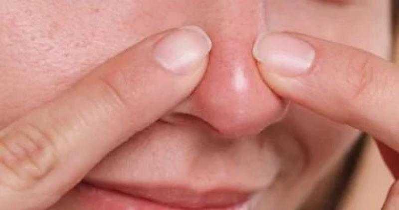 وصفات طبيعية للتخلص من الجلد الميت والرؤوس البيضاء في الذقن والخدود