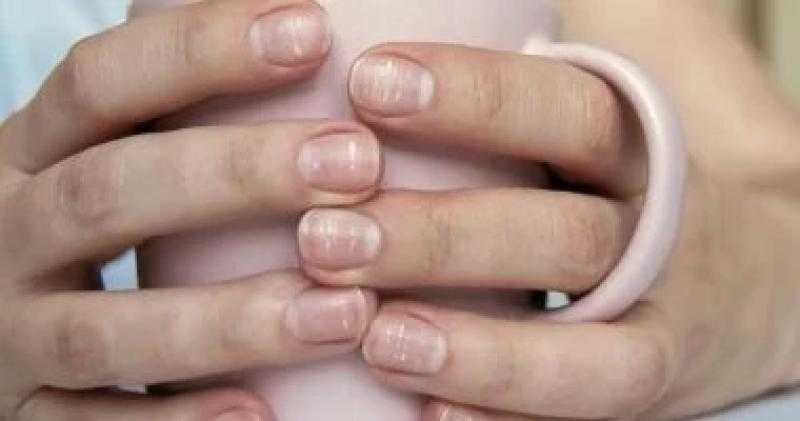 علامات على الأظافر تشير إلى حالات صحية كامنة لا تتجاهلها