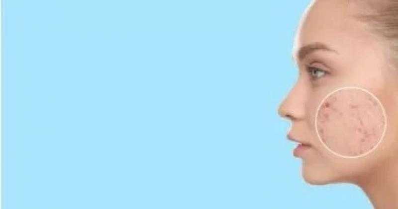 5 أسباب لإصابة بعض النساء بـ حب الشباب بعد الـ 30