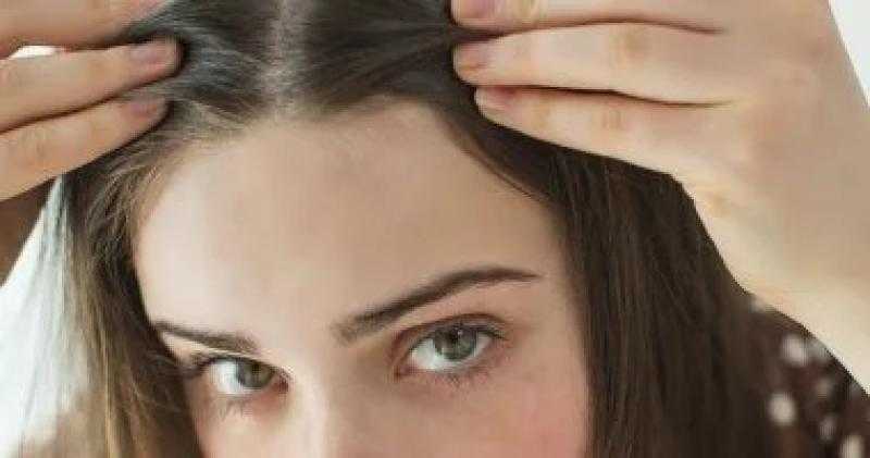 وصفات طبيعية للتخلص من الشعر الأبيض خاصة لو فى بداية الثلاثين