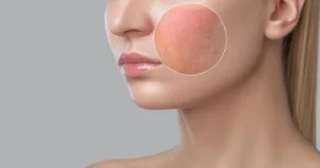 وصفات طبيعية لعلاج المسام المفتوحة