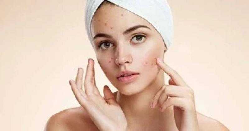 طرق طبيعية للتحكم فى حب الشباب من نظامك الغذائى