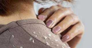 أسباب قشرة الشعر وطرق العلاج