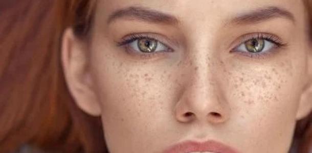 النمشات والبقع الدموية على الجلد.. إشارات صغيرة قد تكشف اضطرابا داخل الجسم