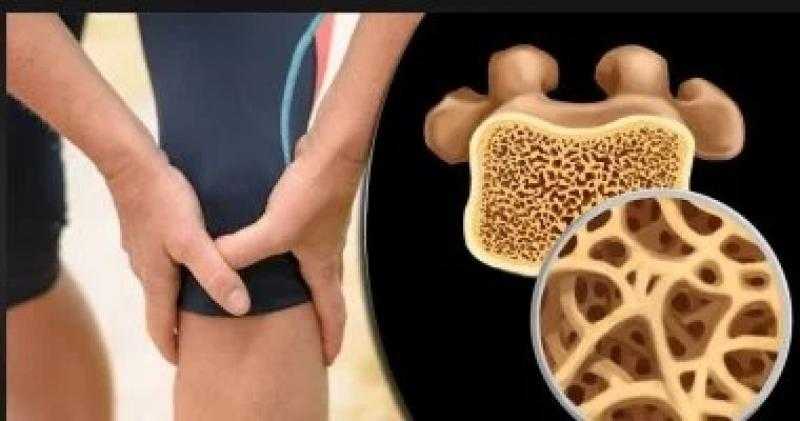 6 أطعمة تقلل خطر الإصابة بكسور العظام لدى المصابين بالهشاشة