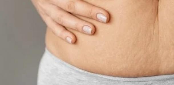 5 وصفات طبيعية للتخلص من السلوليت من غير تعقيد