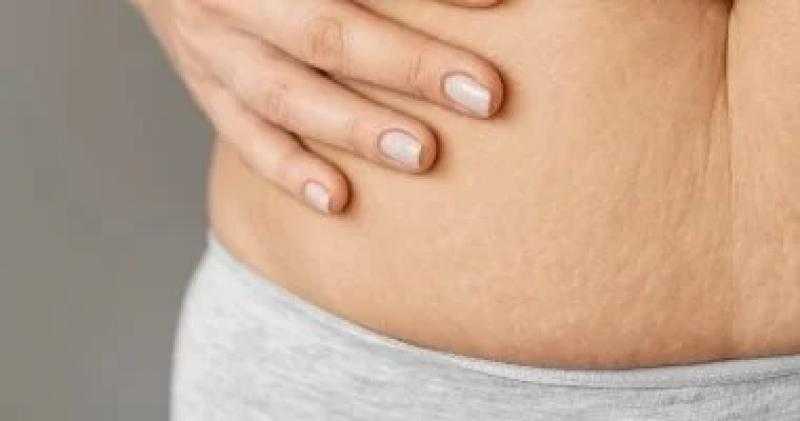 5 وصفات طبيعية للتخلص من السلوليت من غير تعقيد