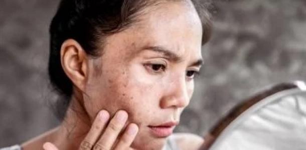 خطوات التخلص من البقع الداكنة في البشرة.. استعيدى نضارتها تدريجيًا