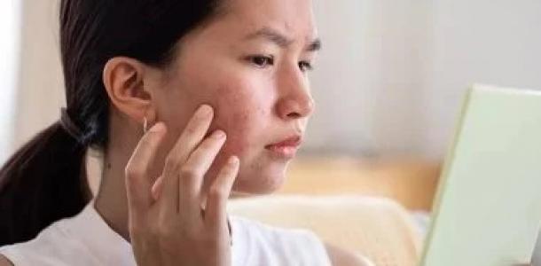 وصفات طبيعية للتخلص من حب الشباب