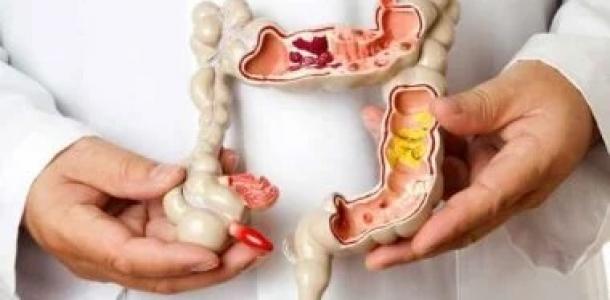 تناول اللحوم الحمراء يزيد من حدة أعراض هذا المرض المعوى