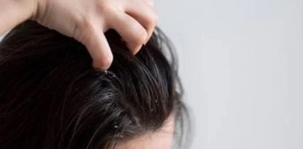 وصفات طبيعية لعلاج مشكلة قشرة الرأس