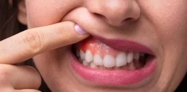 علامات تظهر على الفم تدل على التوتر وسوء التغذية