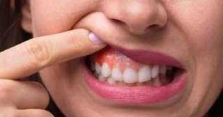 علامات تظهر على الفم تدل على التوتر وسوء التغذية