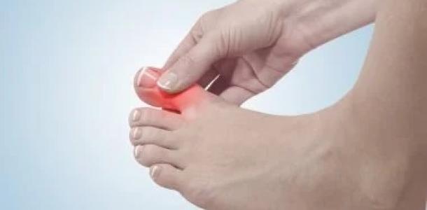 لمرضى النقرس.. هل تزيد البروتينات النباتية من حمض اليوريك؟