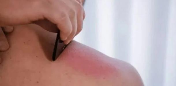 من فروة الرأس للظهر.. ترند الخربشة تجربة غير تقليدية للتخلص من التوتر