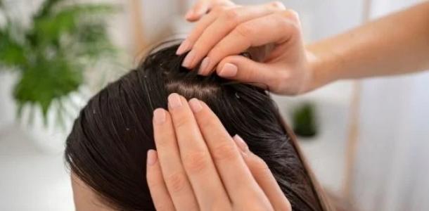 أسباب ظهور قشرة الشعر.. عادات يومية تزيد المشكلة وطرق التعامل معها